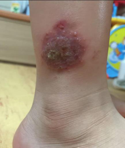 치료 전 - 건선 + 아토피 증상