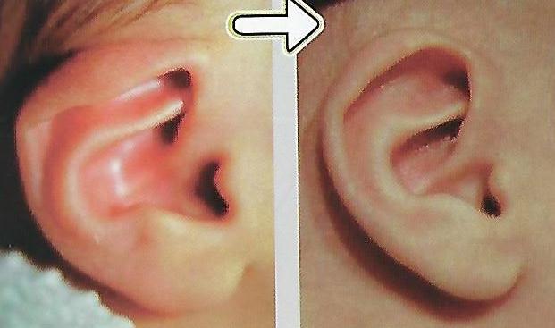 늘어진귀 교정 전후