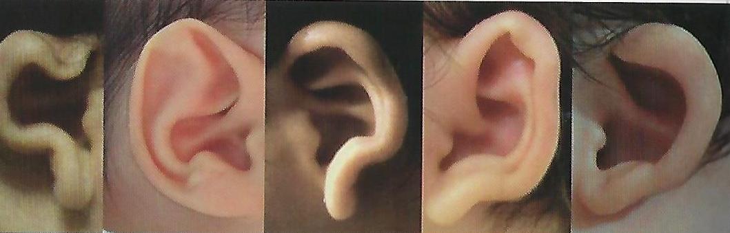 당나귀 귀/돌출귀/쪽박귀 교정 사례