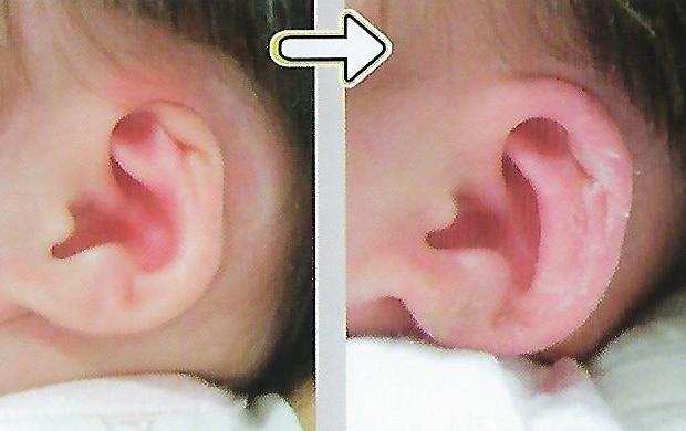 매몰귀 교정 전후