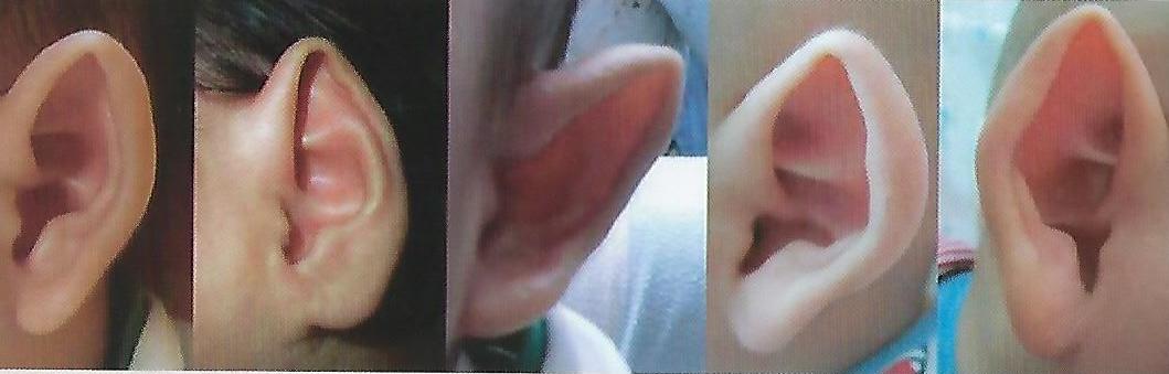 박쥐귀/뾰족귀 교정 사례